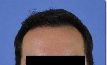 Hair restoration procedure results