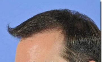 Hair restoration procedure results