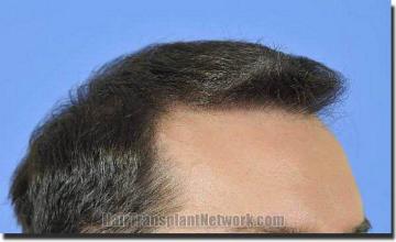 Hair restoration procedure results
