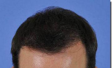 Hair restoration procedure results