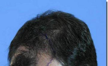 Hair restoration procedure results