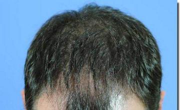 Hair restoration procedure results