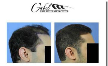 Hair restoration procedure results