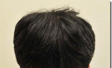 Hair restoration procedure results