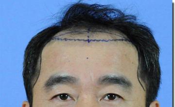 Hair restoration procedure results