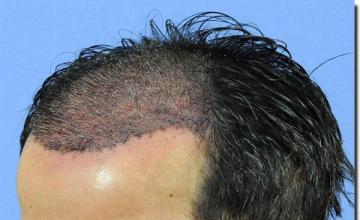 Hair restoration procedure results