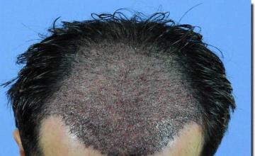 Hair restoration procedure results