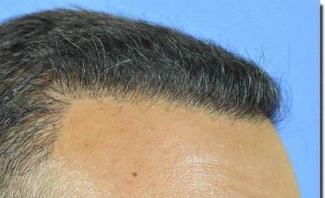 Hair restoration procedure results