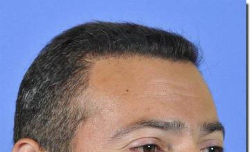 Hair restoration procedure results