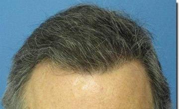 Hair restoration procedure results