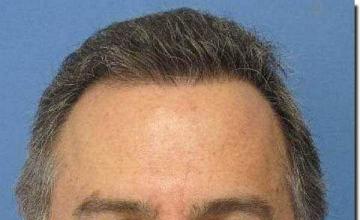 Hair restoration procedure results