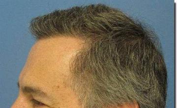 Hair restoration procedure results