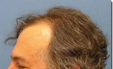 Hair restoration procedure results