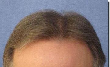 Hair restoration procedure results