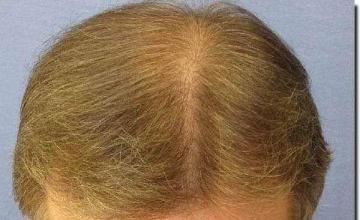 Hair restoration procedure results