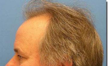 Hair restoration procedure results