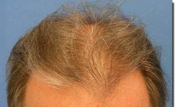 Hair restoration procedure results