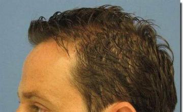 Hair restoration procedure results