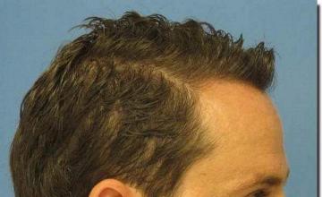 Hair restoration procedure results