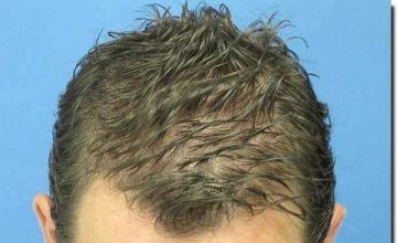 Hair restoration procedure results