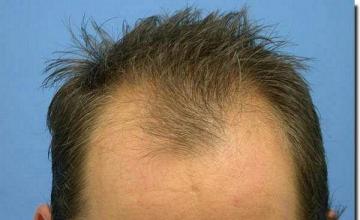 Hair restoration procedure results