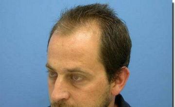 Hair restoration procedure results