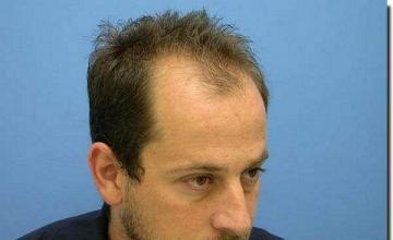 Hair restoration procedure results