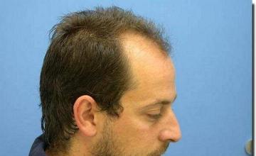 Hair restoration procedure results