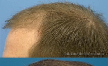 Hair transplant surgery before and after pictures