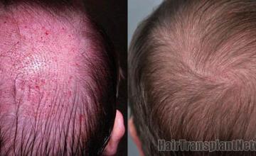 Hair transplantation surgery before and after images