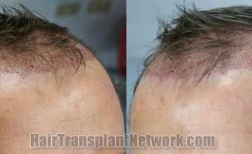 Hair restoration surgery before and after photos