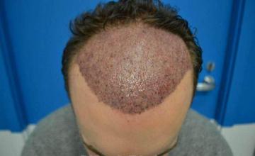 Hair transplantation surgery before and after pictures