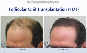 Hair transplantation surgery before and after images