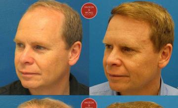 Hair transplant surgery before and after photos