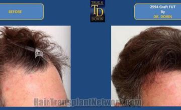 Hair transplantation surgery before and after images