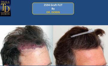 Hair transplant surgery before and after photos