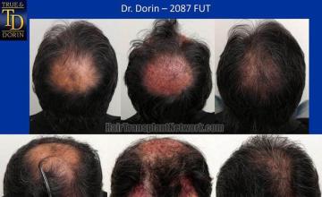 Hair transplantation surgery before and after photos