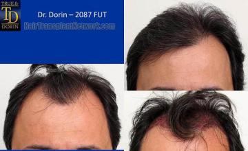 Hair restoration procedure before and after results