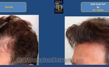 Hair transplantation surgery before and after pictures