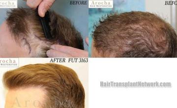 Hair transplantation surgery before and after pictures