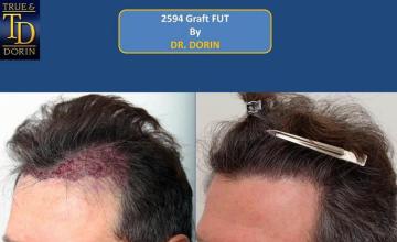 Hair transplant surgery before and after images