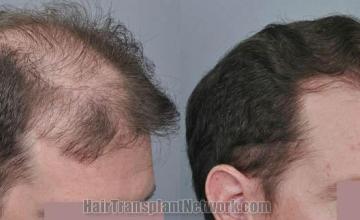 Hair transplantation surgery before and after pictures