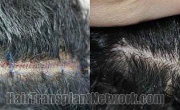 Surgical hair transplantation result photographs