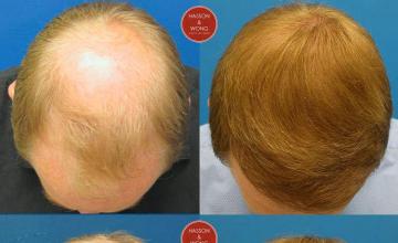 Top view before and after hair restoration results