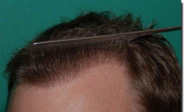 Hair restoration procedure results