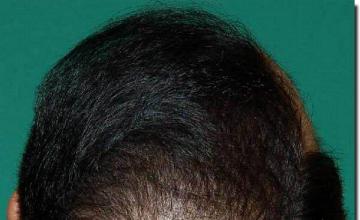 Hair restoration procedure results