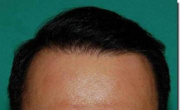 Hair restoration procedure results