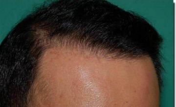 Hair restoration procedure results