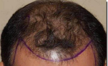 Hair restoration procedure results