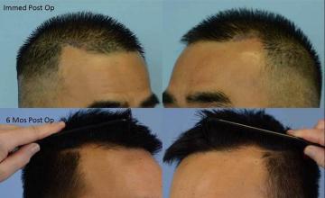 Hair transplantation surgery before and after images